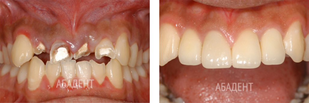 Металлокерамическое протезирование зубов