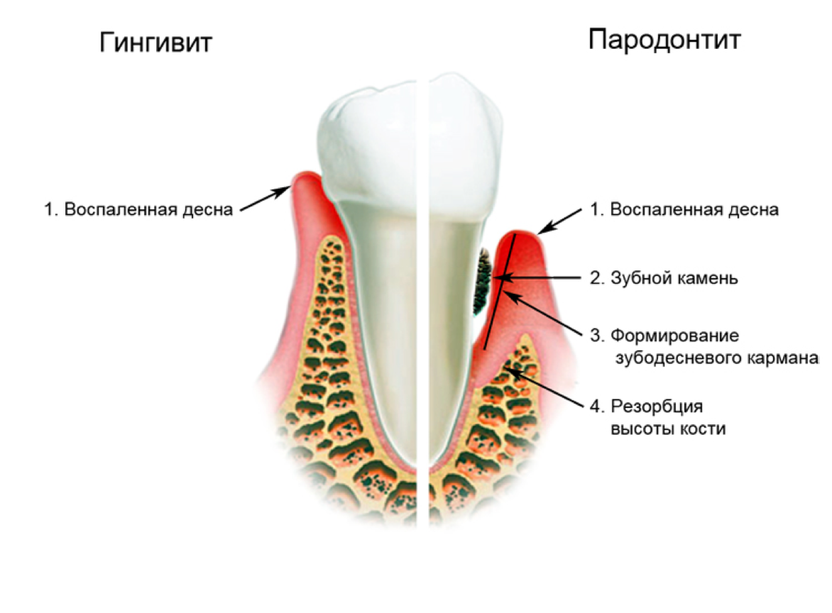 Ноют зубы лечение