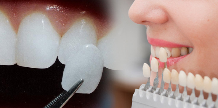 Винирное восстановление зубов - подбор винира 