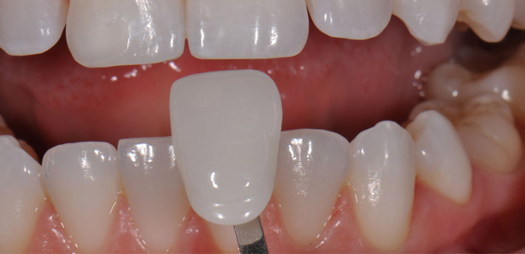 Винирное восстановление зубов