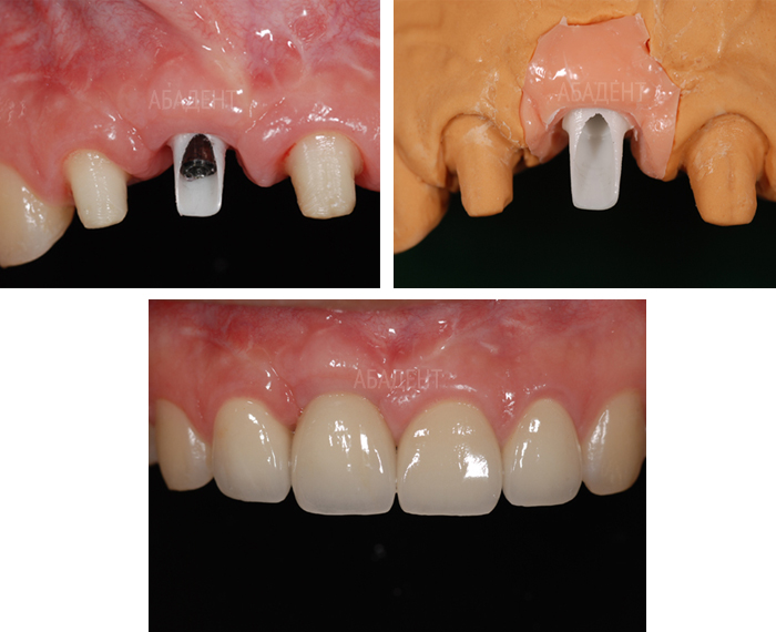 Одновременное изготовление безметалловых керамических коронок на собственных зубах и имплантате с циркониевым абатментом
