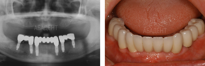 'этапы имплантации зубов.