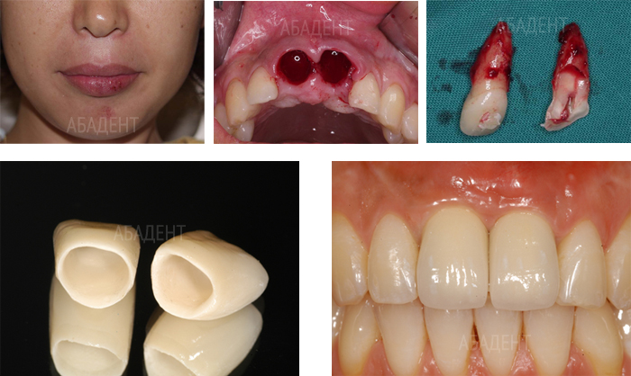 'Травма нижней части лица с потерей центральных зубов верхней челюсти. Восстановление передних зубов на имплантатах с применением цельнокерамических коронок на оксиде циркония.