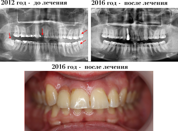Рекомендовано удалении зуба мудрости на нижней челюсти по ортодонтическим показаниям