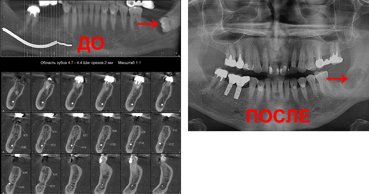 Компьютерная томограмма для дентальной имплантации на нижней челюсти слева и рентгенограмма ретенированного зуба мудрости справа