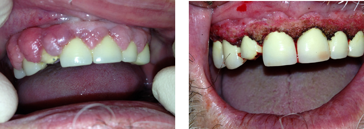 Боль после удаления зуба