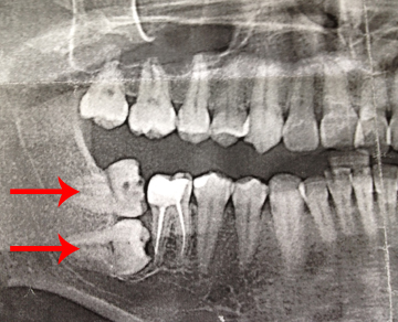 Компьютерная томограмма для дентальной имплантации на нижней челюсти слева и рентгенограмма ретенированного зуба мудрости справа