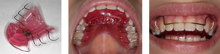 Съемная пластинка верхней челюсти с ортодонтическими элементами