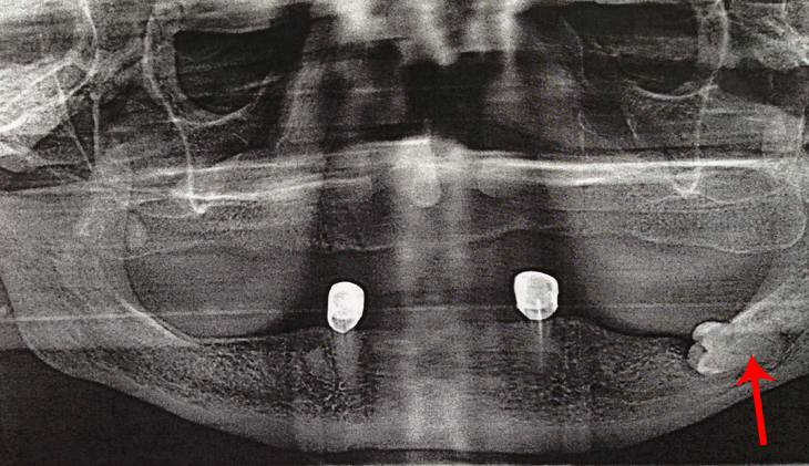 Для удаления данного зуба необходимо провести компьютерную томограмму окружающей кости чтобы исключенить перелом нижней челюсти 