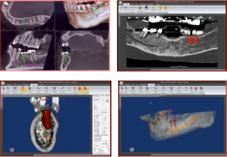 Планирование имплантации зубов с применением технологий 3D моделирования
