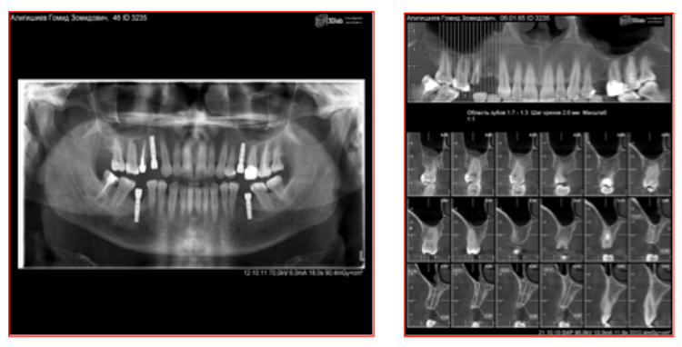 Панорамный снимок  имплантация зубов
