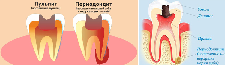 Лечение зуба под коронкой