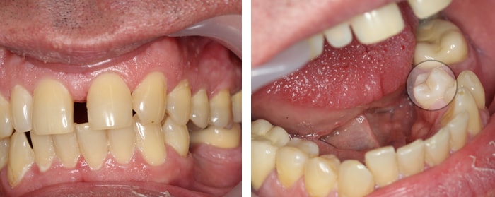 Аномалия положение зубов