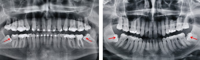 Аномалия положение зубов