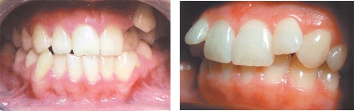 Аномалия положение зубов и зубных рядов