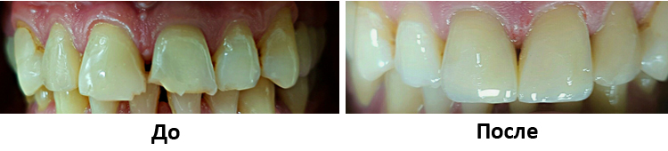Лечение кариеса методом художественной реставрации 